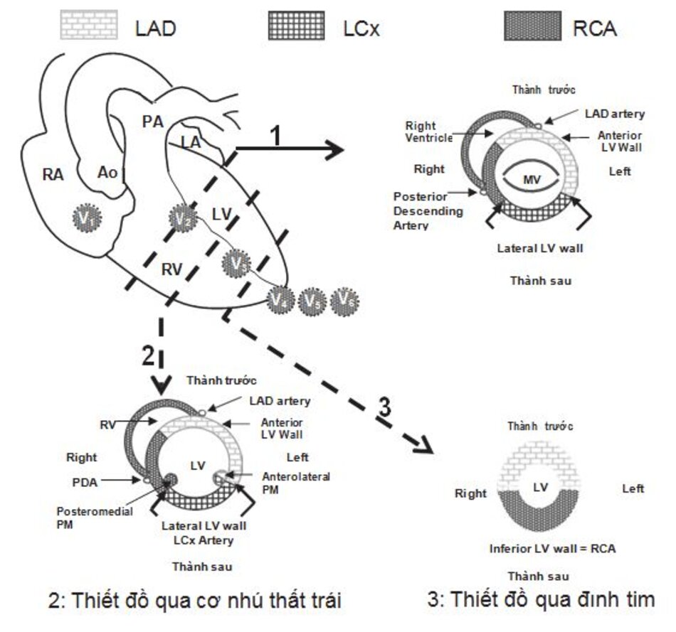 Hình 23.13: Bản đồ cấp máu cơ tim của các động mạch vành. Sơ đồ ở góc trên trái cho thấy mặt trước của tim. Thất trái được cắt ngang bởi ba lát cắt được đánh số 1, 2, 3. Lắt cắt số 1 đi ngang mức van hai lá tương ứng với phần đáy của thất trái. Thiết đồ 1 được cho ở góc trên phải. Lát cắt số 2 tương ứng với phần giữa của thất trái và thiết đồ được cho ở góc dưới trái. Lát cắt số 3 tương ứng với phần đı ̉nh tim và thiết đồ được cho ở góc dưới phải. Ao: Động mạch chủ; LA: nhı ̃ trái; LV: thất trái; LAD: động mạch liên thất trước; LCx: động mạch mũ; MV: van hai lá; PA: động mạch phổi; PDA: động mạch liên thất sau; PM: cơ nhú; RA: nhı ̃ trái; RCA: động mạch vành phải; V1 đến V6: các chuyển đạo trước tim.