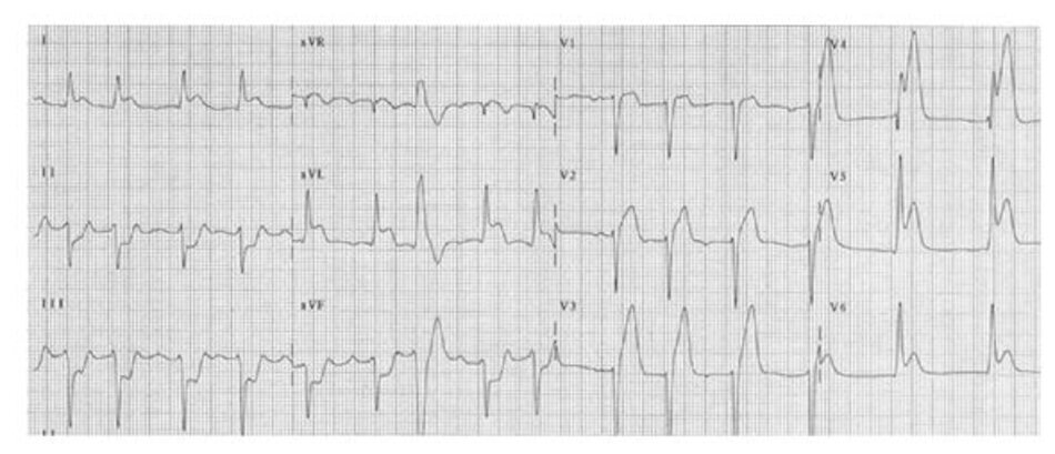 Hình 23.15: Nhồi máu cơ tim trước rộng. ST chênh lên được thấy ở V1-V6, I và aVL. Chụp mạch vành cho thấy tắc hoàn toàn đoạn gần của động mạch liên thất trước (LAD). Chú ý rằng ST chênh lên ở DI và aVL là vı ̀ liên quan với nhánh chéo D1 (thường là nhánh đầu tiên của LAD). ST chênh xuống ở DII, DIII và aVF là do soi gương với ST chênh lên ở DI và aVL.