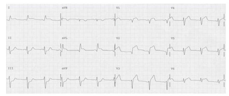 Hình 23.16: Nhồi máu cơ tim trước rộng. ST chênh lên ở V1-6, DI và aVL. Chụp mạch vành cho thấy tắc hoàn toàn đoạn gần của LAD. ECG này hoàn toàn tương tự với hınh 23.15.