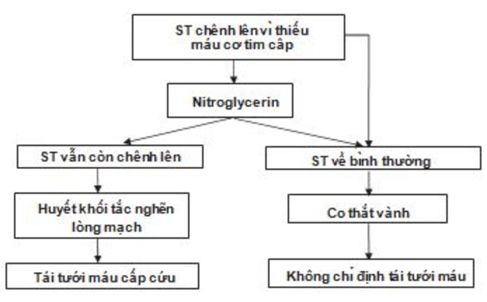 Hình 23.2: Thiếu máu cơ tim có ST chênh lên ST chênh lên bởi huyết khối tắc nghẽn mạch vành thì dai dẳng và thường không đáp ứng với thuốc giãn vành, trong khi đó, ST chênh lên do co thắt vành thường thường thoáng qua và đáp ứng tốt với thuốc giãn vành.