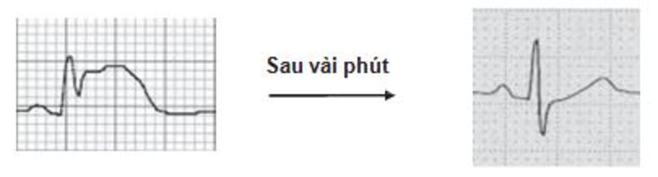 Hình 23.3: Co thắt vành. ST chênh lên trong co thắt vành là không thể phân biệt được với ST chênh lên do huyết khối tắc nghẽn. Tuy nhiên ST chênh lên trong co thắt vành thường chı thoáng qua và có thể đảo ngược được với nitroglycerin trong khi ST chênh lên do huyết khối tắc nghẽn thường kéo dài và không đáp ứng với thuốc giãn vành.