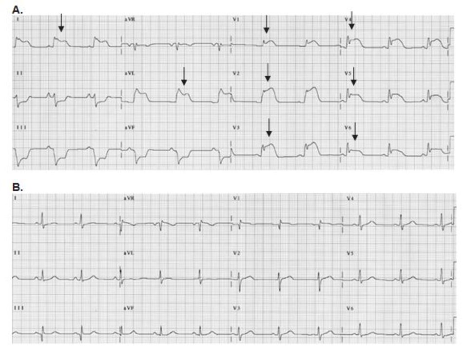 Hình 23.4: Co thắt vành. Điện tim A và B được đo từ cùng một bệnh nhân. (A) ST chênh lên nhiều chuyển đạo (mũi tên) có thể do huyết khối tắc nghẽn hoặc co thắt vành. (B) Sau khi dùng nitroglycerin, ST trở về đẳng điện chı ̉ sau vài phút, điều này chứng tỏ nguyên nhân là do co thắt vành. Chụp mạch vành cũng cho thấy lòng mạch hoàn toàn trơn láng và không có huyết khối tắc nghẽn.