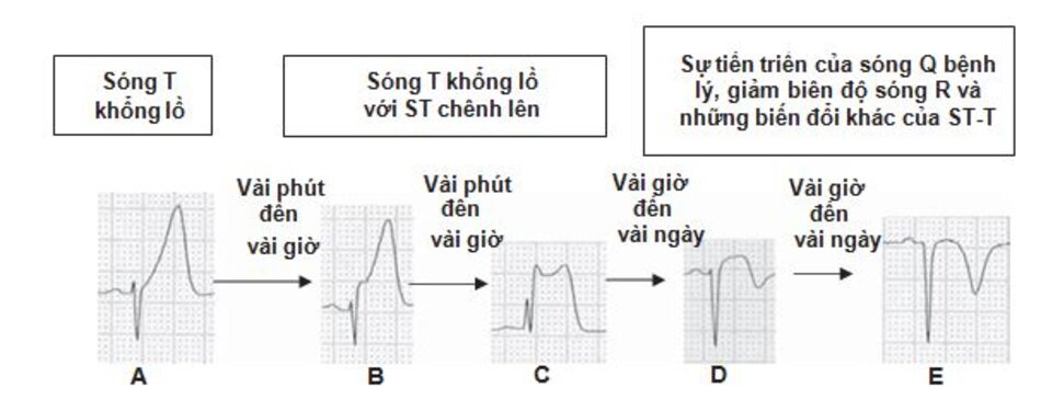 Hınh 23.5: Nhồi máu cơ tim ST chênh lên (STEMI). Sóng T khổng lồ (hyperacute) đánh dấu vùng thiếu máu cục bộ (A-C) theo sau bởi ST chênh lên (B,C), giảm biên độ sóng R (D) hoặc sự phát triển của sóng Q bệnh lý (E) và sự đảo ngược của sóng T (D,E). Sự tiến triển của STEMI từ sóng T khổng lồ đến sóng Q bệnh lý có thể hoàn thành trong 6h sau khi khởi phát triệu chứng nhưng cũng có thể tiến triển chậm hơn trong vài ngày.