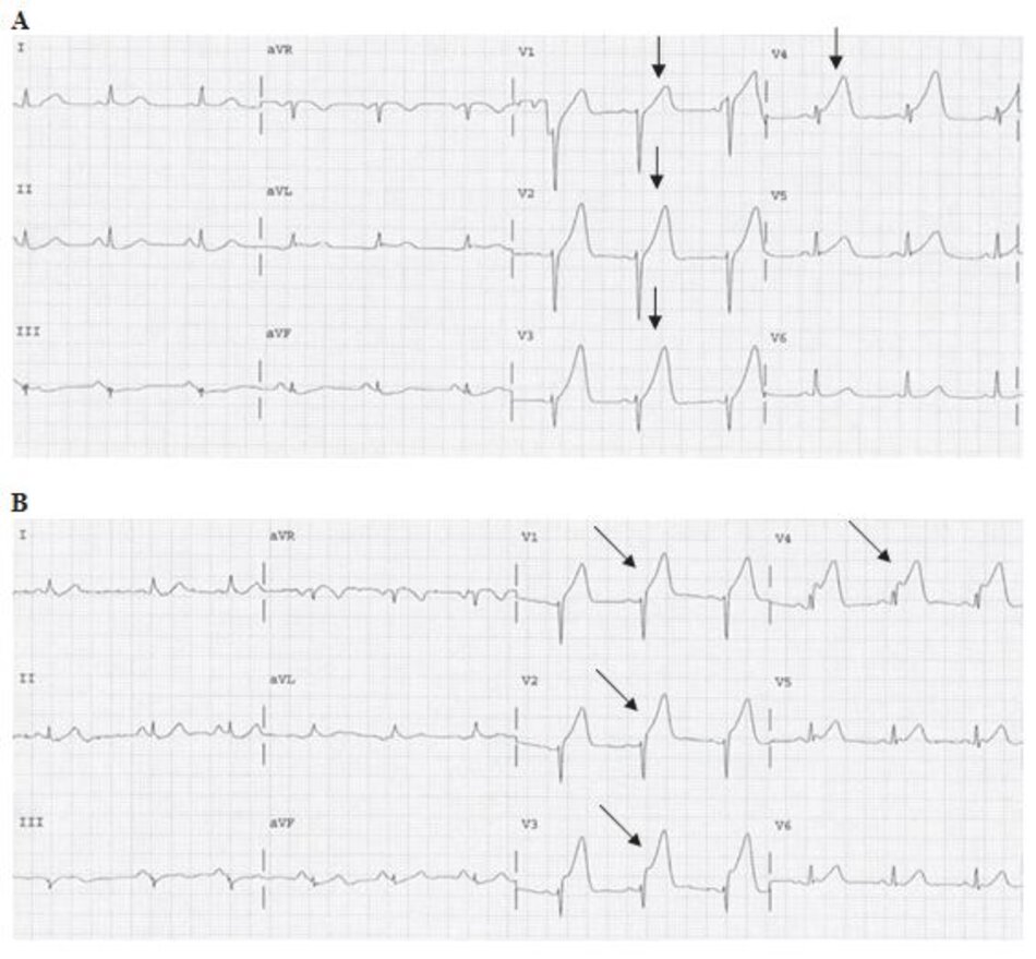 Hınh 23.6: (A) Sóng T khổng lồ. ECGA đầu tiên là của một bệnh nhân vào viện vı ̀ khởi phát đau ngực cấp. Sóng T cao, khổng lồ (mũi tên) từ V1 đến V4 với ST chênh lên ở V3-V4. Lưu ý rằng sóng T khổng lồ cũng cho biết được vị trí của động mạch bị tắc và thường xuất hiện đầu tiên, trước cả khi đoạn ST bắt đầu chênh lên. Các ECG tiếp theo được ghi lại trong hınh (B-D). (B) Nhồi máu cơ tim ST chênh lên (STEMI). ECG này được ghi lại 15 phút sau ECG đầu tiên, ngoài sóng T khổng lồ, ST chênh lên càng mạnh hơn từ B V1-V4(mũi tên). (còn tiếp)