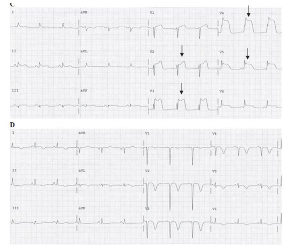 CHınh 23.6: ( tiếp tục) (C) Nhồi máu cơ tim ST chênh lên. ECG trên được ghi lại khoảng 1.5h sau ECG đầu tiên (hınh A). Đoạn ST tiếp tục chênh lên thậm chı ́ sau liệu pháp tiêu sợi huyết. ST chênh lên trở nên càng rõ ở V2-V6 và chênh lên nhẹ ở II, III, aVF. Sóng T khổng lồ vẫn tiếp tục hiện diện ở V2- V5 (mũi tên). (D) Nhồi máu cơ tim ST chênh lên. ECG này được ghi lại 13 ngày sau đó. Ta thấy xuất hiện phức bộ QS và sự giảm biên độ của sóng r từ V1 đến V5. D Đoạn ST lúc này đã trở về đẳng điện và sóng T thı ̀ đảo ngược từ V1-V6 và chuyển đạo I, II, aVL.