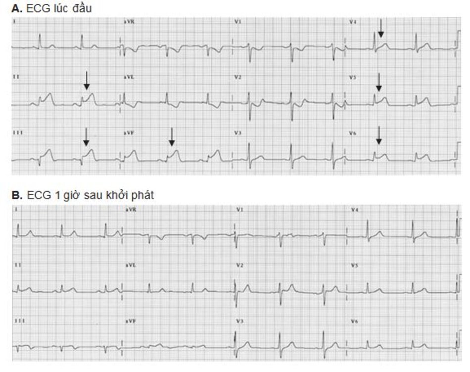 CHınh 23.6: ( tiếp tục) (C) Nhồi máu cơ tim ST chênh lên. ECG trên được ghi lại khoảng 1.5h sau ECG đầu tiên (hınh A). Đoạn ST tiếp tục chênh lên thậm chı ́ sau liệu pháp tiêu sợi huyết. ST chênh lên trở nên càng rõ ở V2-V6 và chênh lên nhẹ ở II, III, aVF. Sóng T khổng lồ vẫn tiếp tục hiện diện ở V2- V5 (mũi tên). (D) Nhồi máu cơ tim ST chênh lên. ECG này được ghi lại 13 ngày sau đó. Ta thấy xuất hiện phức bộ QS và sự giảm biên độ của sóng r từ V1 đến V5. D Đoạn ST lúc này đã trở về đẳng điện và sóng T thı ̀ đảo ngược từ V1-V6 và chuyển đạo I, II, aVL.