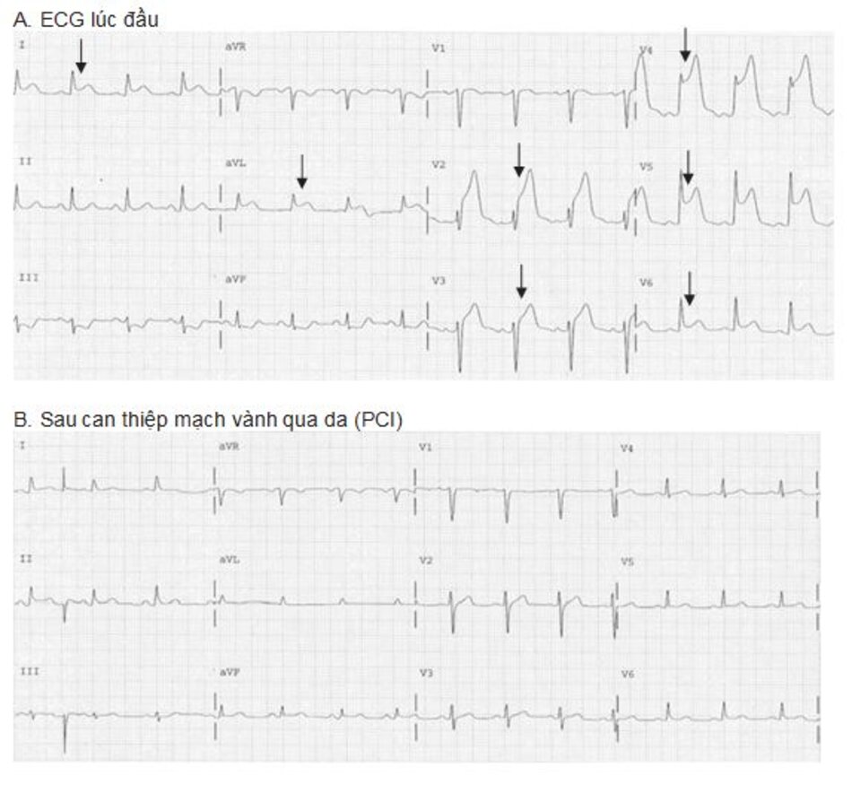 Hình 23.8: Nhồi máu cơ tim ST chênh lên. ECG (A) cho thấy ST chênh lên ở V2-V6, DI và aVL (mũi tên). Chụp mạch vành cho thấy tắc hoàn toàn đoạn gần của động mạch liên thất trước (LAD). ECG (B) được ghi lại 4 giờ sau khi PCI thành công. Đoạn ST đã trở về đẳng điện và không có sự hiện diện của sóng Q bệnh lý, một dấu hiệu cho thấy tái tưới máu thành công.