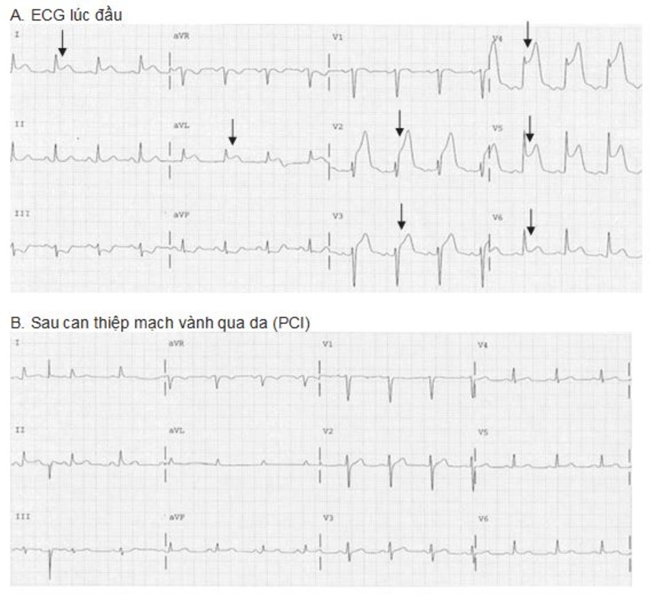 Hình 23.7: Nhồi máu cơ tim ST chênh lên. ECG (A) được ghi lại trước khi liệu pháp tiêu sợi huyết được thực hiện. ST chênh lên ở II, III, aVF và V4-V6 (mũi tên) với ST chênh xuống ở V1-V2. (B) được ghi lại 1 giờ sau khi dùng thuốc tiêu sợi huyết. ST chênh lên ở các chuyển đạo thành dưới bên gần như không còn và sóng T đảo ngược hiện diện ở chuyển đạo III đều là những dấu hiệu của tái tưới máu thành công.