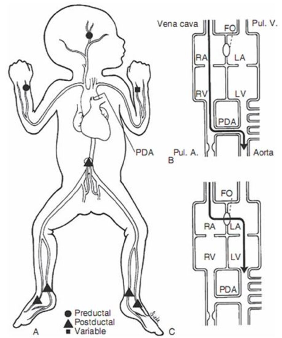 Hình 10-4 Shunting máu trong tăng áp động mạch phổi. A, Vị trí lấy mẫu máu. B, shunt từ phải sang trái qua ống động mạch. C, shunt từ phải sang trái qua lỗ bầu dục. FO, foramen ovale; LA, left atrium; LV, left ventricle; PDA, patent ductus arteriosus; RA, right atrium; RV, right ventricle.