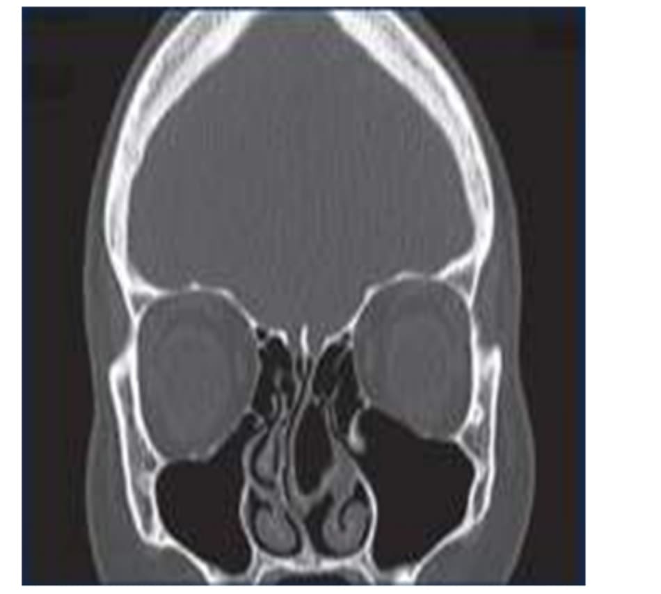 Figure 3–1. Coronal Ctimage showing a large left concha bullosa with severely deviated nasal septum to the right, and nasal polyp at the lateral aspect, which can contribute to postnasal drain- age.