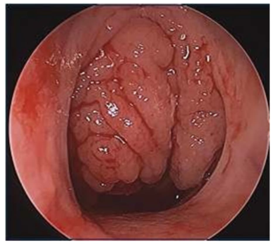 Figure 3–3. this is an endoscopic view of the left poste- rior nasal cavity with significant adenoid hypertrophy obstructing the nasopharynx, which can be a cause of postnasal drainage.