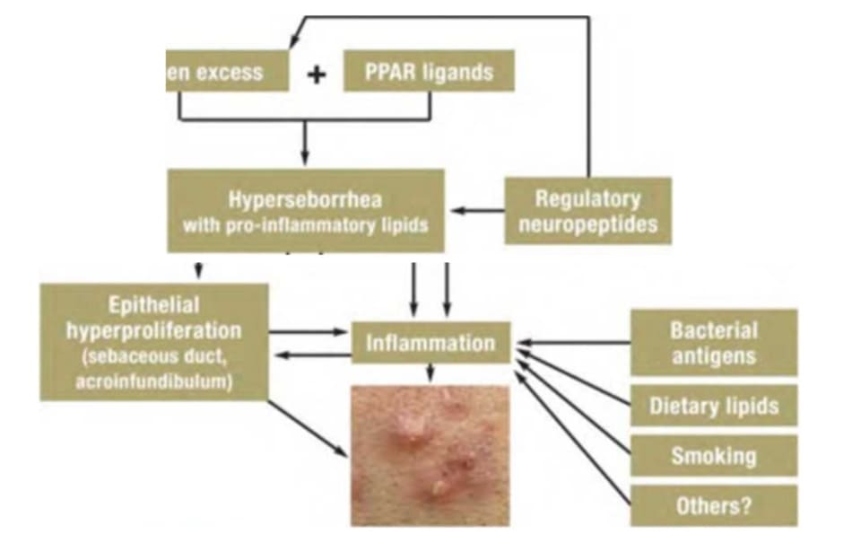 Hình 19,1 Các khía cạnh hiện tại của bệnh sinh mụn trứng cá. Các nội tiết tố androgen, phối tử lipid của thụ thể kích hoạt tăng sinh peroxisome (PPAR), các neuro-peptit điều hòa với hoạt động nội tiết tố và phi nội tiết tố và các yếu tố môi truờng dẫn đến tăng tiết bã nhờn, tăng sinh biểu mô trong ống tuyến bã nhờn, cổ nang lông và biểu hiện của các chemokine/cytokine gây viêm, kích thích sự phát triển của nhân mụn trứng cá và tổn thưong mụn viêm.