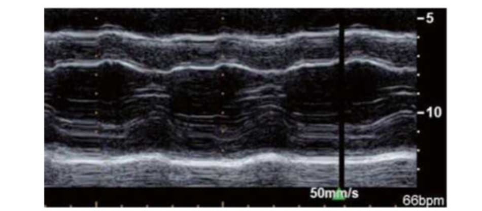 FIGURE 1.3 Echocardiogram showing left ventricular hypertrophy