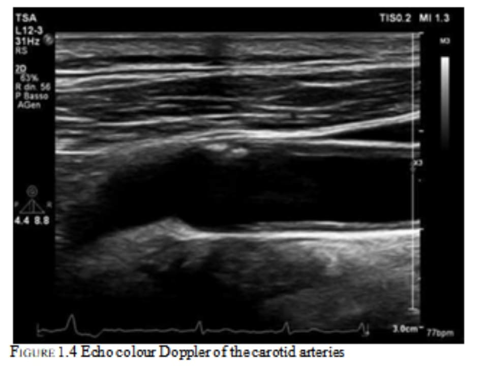 FIGURE 1.4 Echo colour Doppler of the carotid arteries