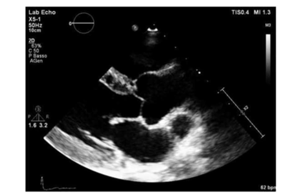 FIGURE 2.2 Echocardiogram: parasternal long axis view