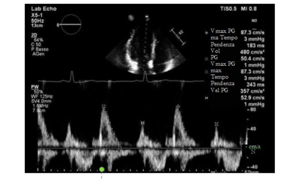 FIGURE 2.3 Echocardiogram: transmitral flow