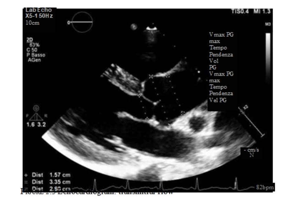 FIGURE 2.4 Echocardiogram: aortic size