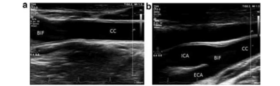 FIGURE 2.5 (a, b) Carotid artery ultrasound. CC, common carotid; BIF, carotid bifurcation; ICA, internal carotid artery; ECA, external carotid artery