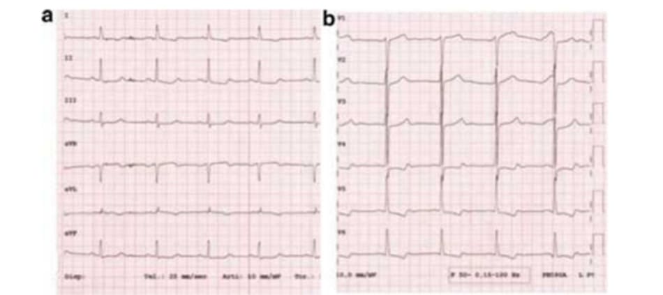 FIGURE 3.2 Electrocardiogram