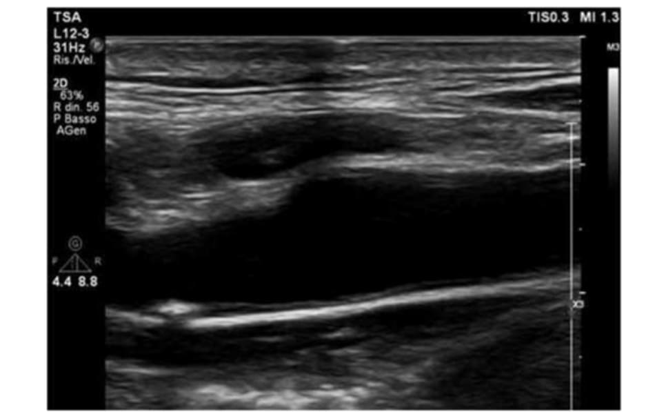 FIGURE 3.3 Carotid ultrasound