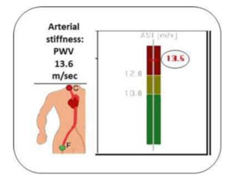FIGURE 3.4 Arterial stiffness: carotid-femoral PWV