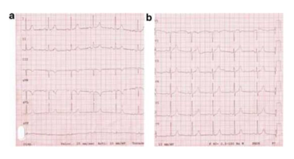 FIGURE 4.1 Electrocardiogram