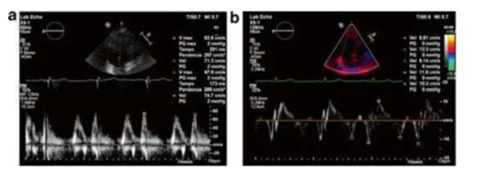 FIGURE 4.3 Echocardiogram: transmitral flow and tissue Doppler analysis