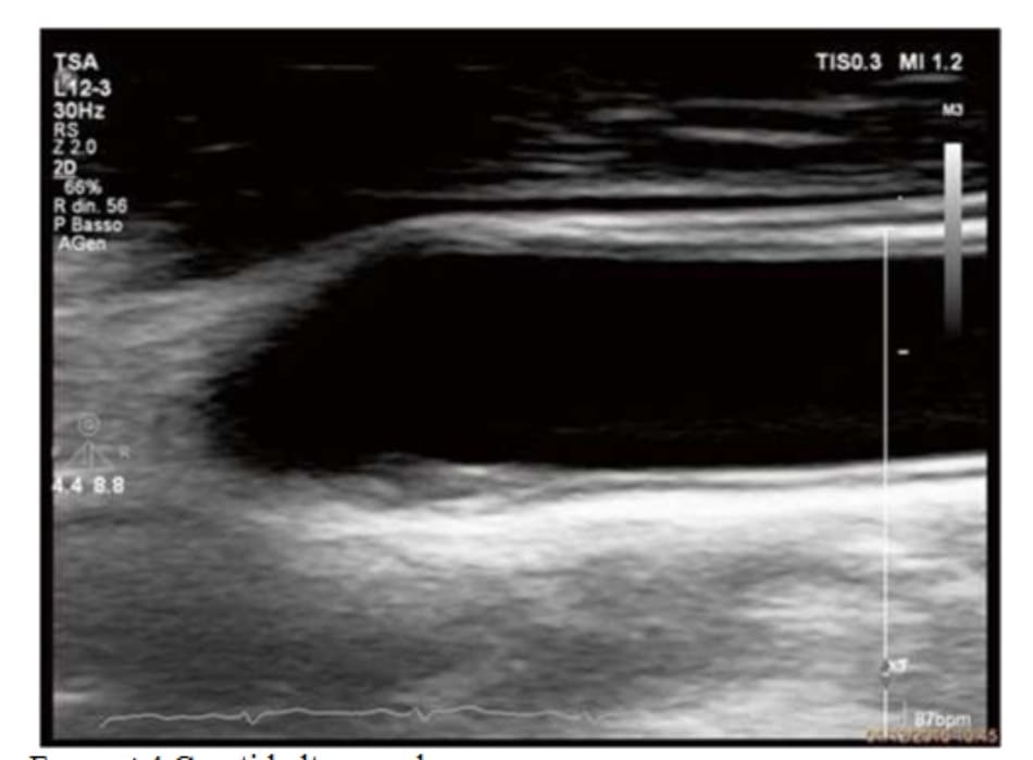 FIGURE 4.4 Carotid ultrasound