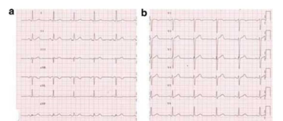 FIGURE 5.1 (a, b) Electrocardiogram