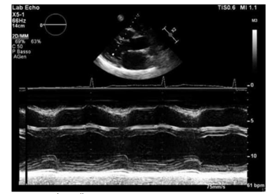 FIGURE 5.2 Echocardiogram