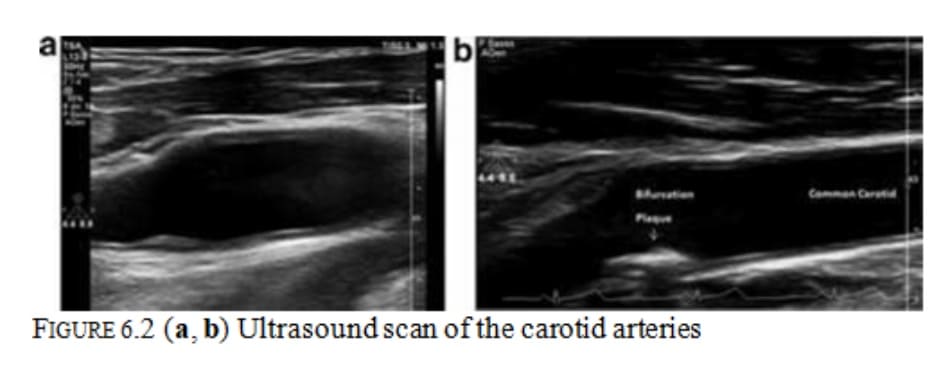 FIGURE 6.2 (a, b) Ultrasound scan of the carotid arteries