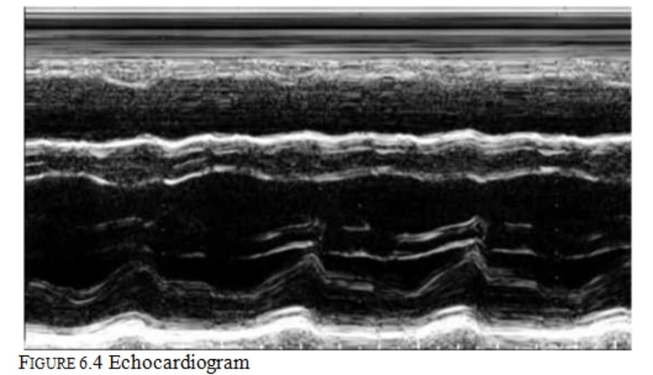 FIGURE 6.4 Echocardiogram