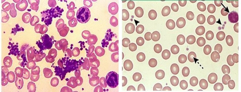 Hình 1: Tăng tiểu cầu trong essential thrombocythemia và Tiểu cầu bình thường trên lam máu 