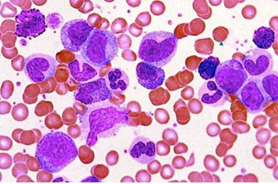 Hình 5: Lam máu của bệnh nhân CML.