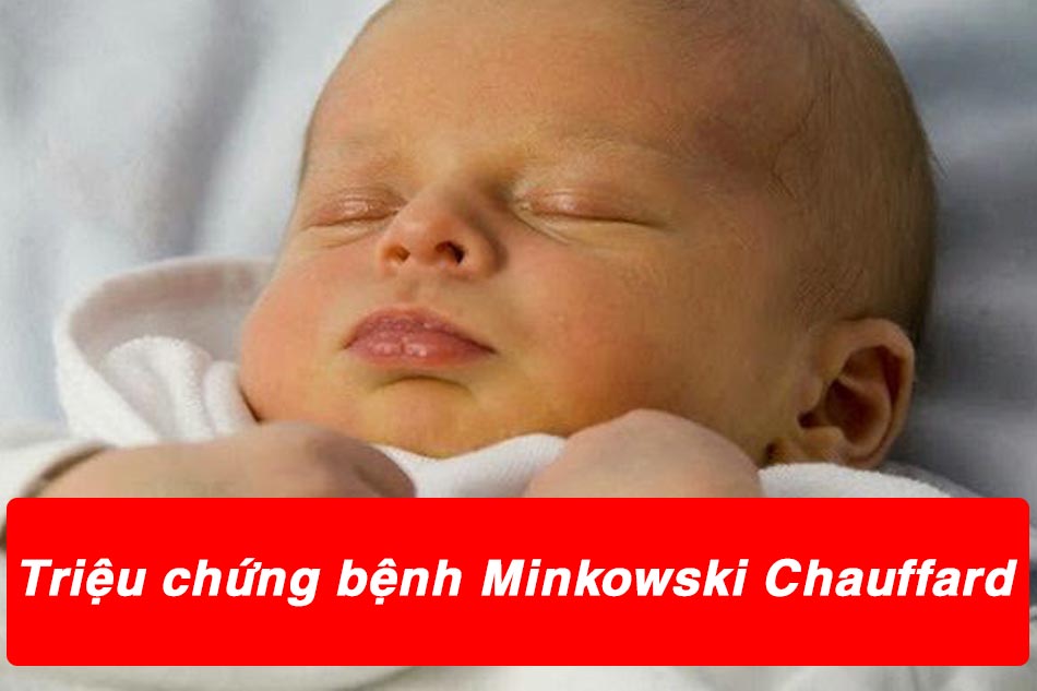 Triệu chứng của bệnh nhân mắc bệnh Minkowski Chauffard