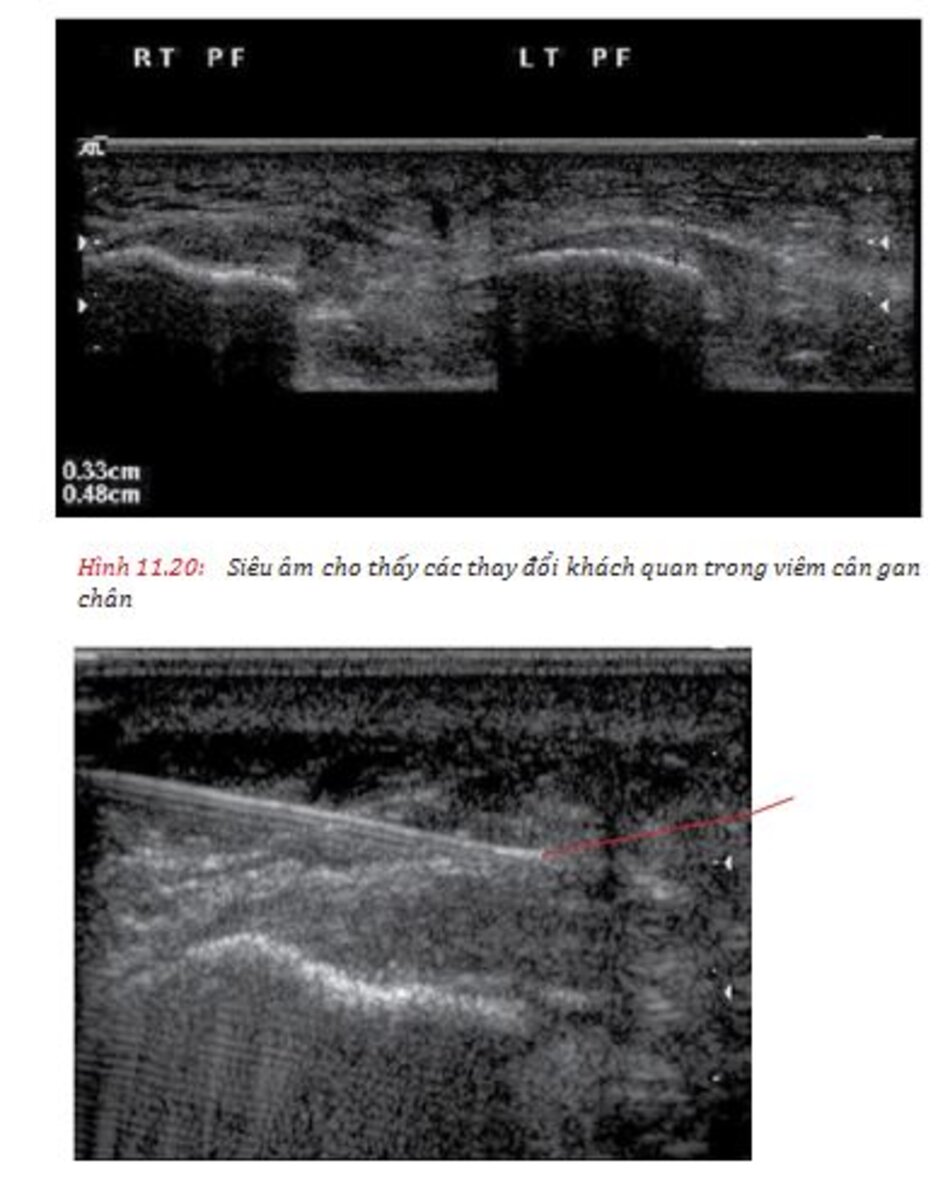 Hình 11.20:Siêu âm cho thấy các thay đổi khách quan trong viêm cân gan chân và Hình 11.21: Tiêm có hướng dẫn siêu âm vào mô quanh gân, xung quanh cân gan chân