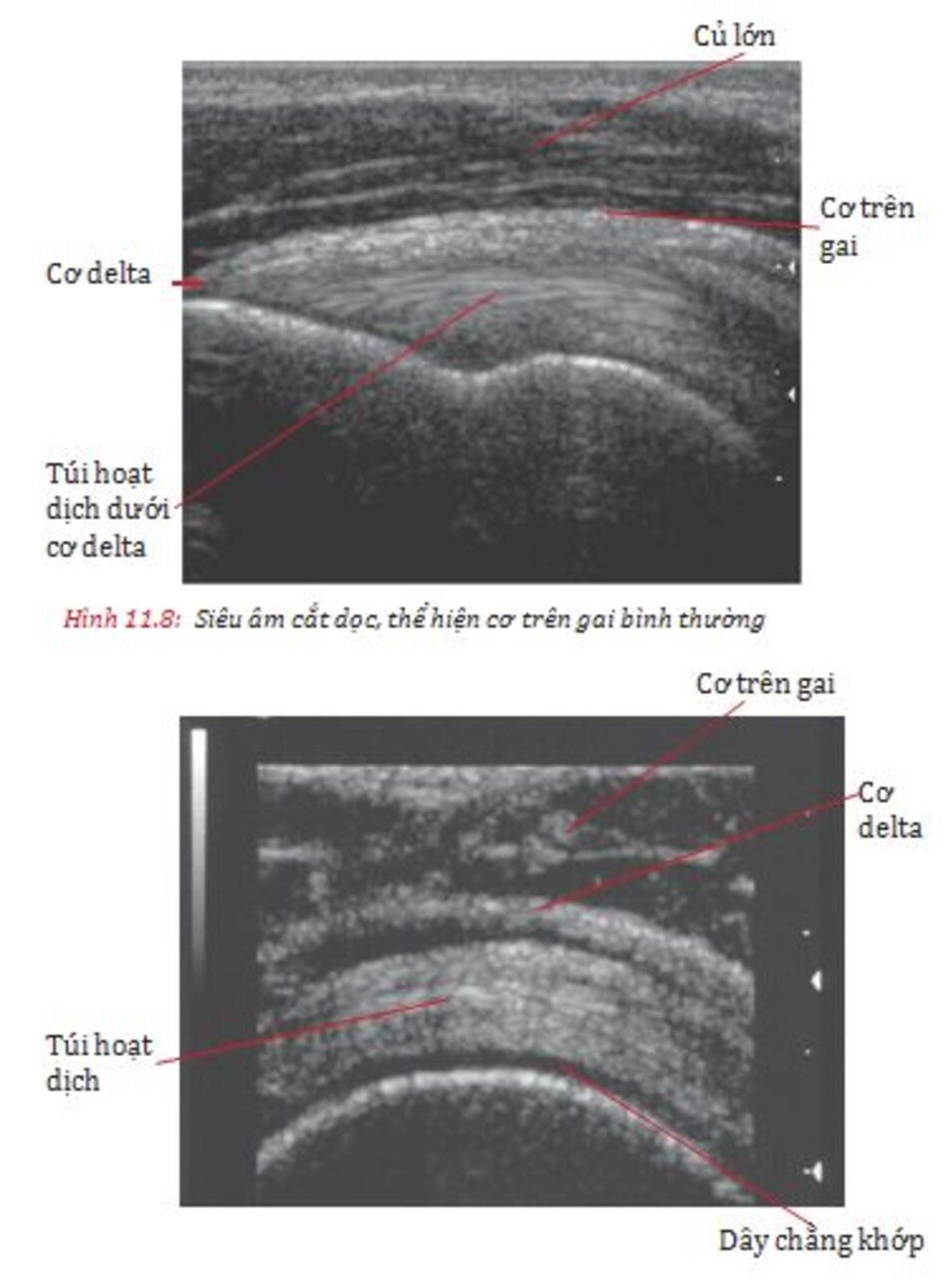 Hình 11.12: MRI thì T2 mặt phẳng trán cho thấy rách toàn bộ gân cơ trên gai và Hình 11.13:MRI thì T2 mặt phẳng trán cho thấy rách toàn bộ gân cơ trên gai 