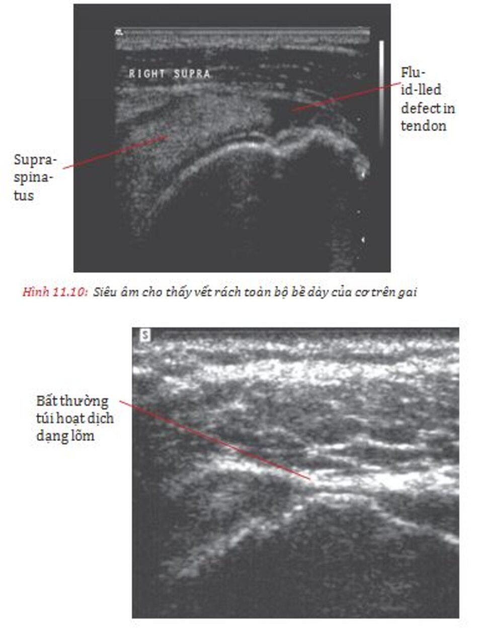 Hình 11.14: MRI khớp cho thấy vết rách cơ trên gai và Hình 11.15: MRI mặt phẳng trán cùng với thuốc cản quang nội khớp cho thấy gân cơ trên gai còn nguyên