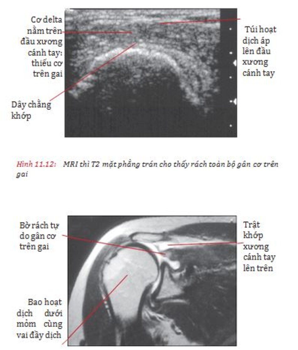 Hình 11.16: Siêu âm cho thấy rách hoàn toàn gân Achilles (mũi tên) và Hình 11.17: Hình ảnh siêu âm cắt dọc của gân gót Achilles