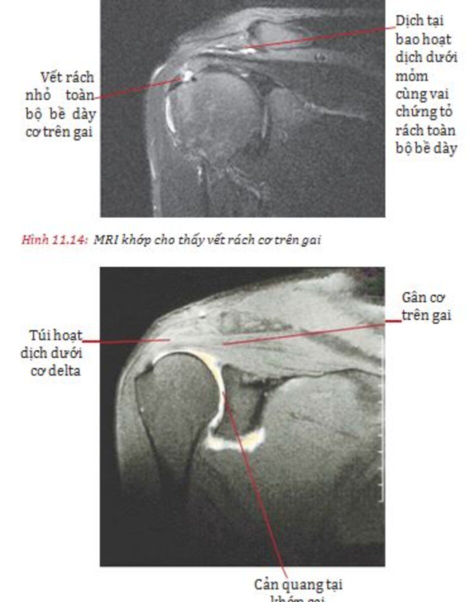 Hình 11.18: Siêu âm trong viêm bao gân hoạt dịch cơ chày sau và Hình 11.19: Siêu âm Doppler màu trong viêm bao gân hoạt dịch cơ chày sau 