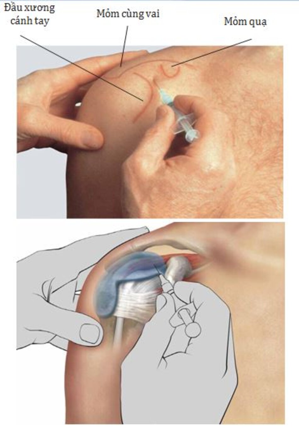 Hình 5.2 Đường tiêm phía trước