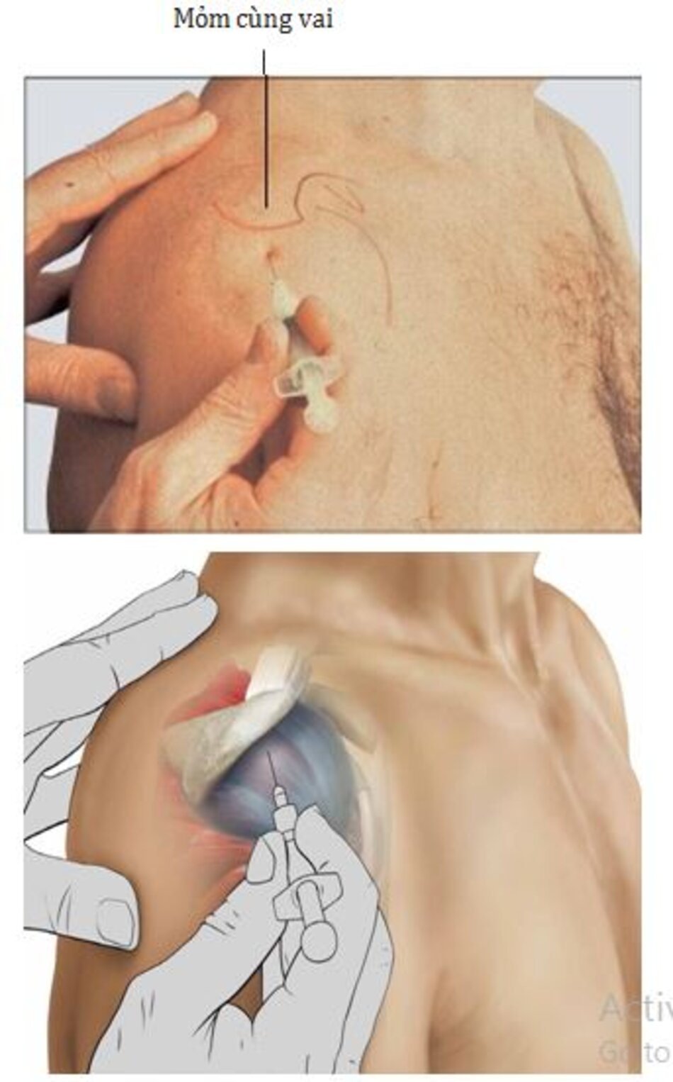 Hình 5.3 Đường tiêm từ ngoài (dưới mỏm cùng vai)