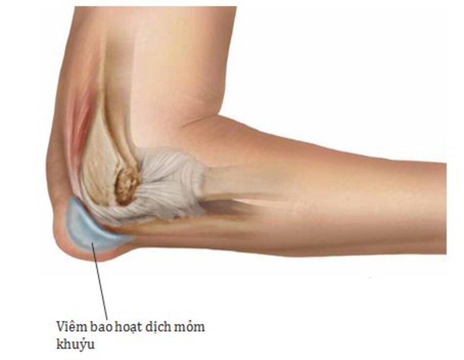 Hình 7.3: Olecranon bursitis.