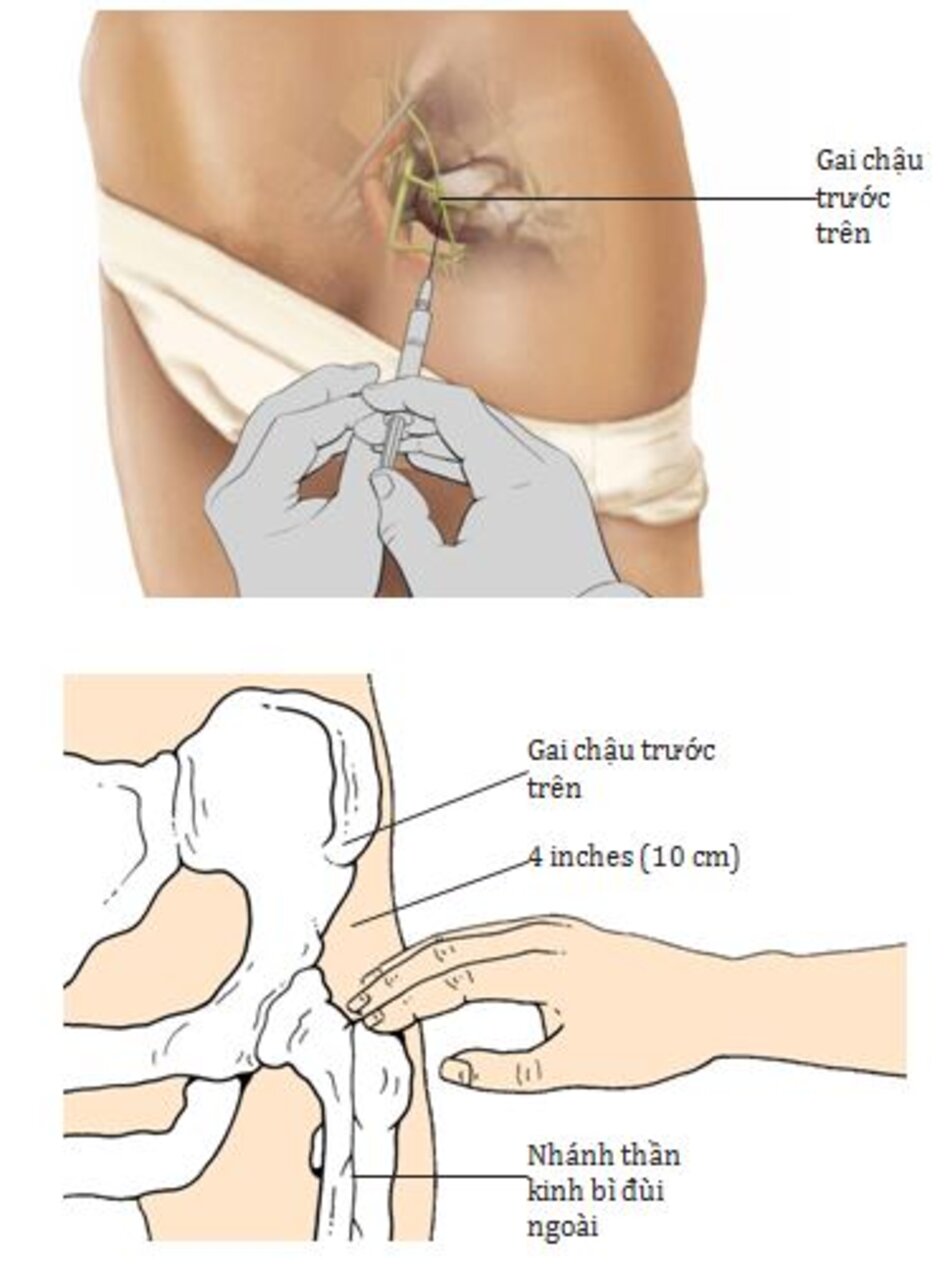 Hình 8.3 Đau đùi dị cảm