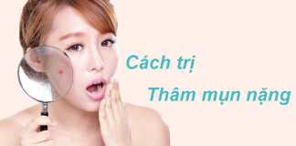 Cách trị thâm mụn nặng