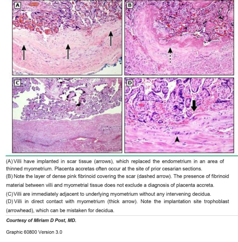 Placenta accreta