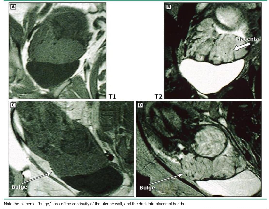 Magnetic resonance image suggestive of placenta accreta
