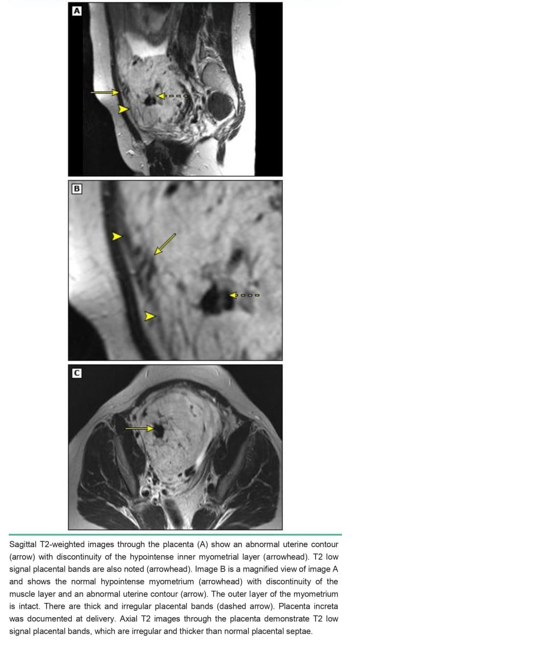 Placenta increta on MRI