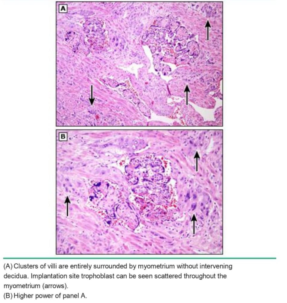 Placenta increta