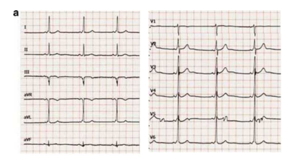 Hình (1,2) Electrocardiogra